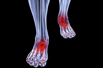 arthritic foot care in the Monmouth County, NJ: Little Silver (Long Branch, Tinton Falls, Asbury Park, Eatontown, Red Bank, Keansburg) and New York County, NY: New York, as well as Hudson County, NJ: Jersey City, Hoboken, Union City, West New York, Secaucus areas