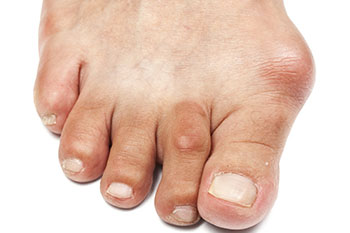 bunions treatment in the Monmouth County, NJ: Little Silver (Long Branch, Tinton Falls, Asbury Park, Eatontown, Red Bank, Keansburg) and New York County, NY: New York, as well as Hudson County, NJ: Jersey City, Hoboken, Union City, West New York, Secaucus areas