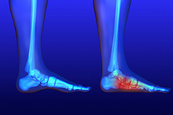 flat feet treatment in the Monmouth County, NJ: Little Silver (Long Branch, Tinton Falls, Asbury Park, Eatontown, Red Bank, Keansburg) and New York County, NY: New York, as well as Hudson County, NJ: Jersey City, Hoboken, Union City, West New York, Secaucus areas