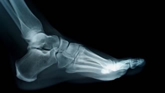 Stress Fractures Treatment in the Monmouth County, NJ: Little Silver (Long Branch, Tinton Falls, Asbury Park, Eatontown, Red Bank, Keansburg) and New York County, NY: New York, as well as Hudson County, NJ: Jersey City, Hoboken, Union City, West New York, Secaucus areas