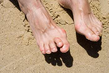 hammertoe treatment in the Monmouth County, NJ: Little Silver (Long Branch, Tinton Falls, Asbury Park, Eatontown, Red Bank, Keansburg) and New York County, NY: New York, as well as Hudson County, NJ: Jersey City, Hoboken, Union City, West New York, Secaucus areas