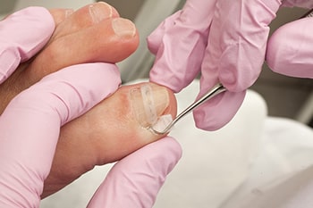 ingrown toenail treatment in the Monmouth County, NJ: Little Silver (Long Branch, Tinton Falls, Asbury Park, Eatontown, Red Bank, Keansburg) and New York County, NY: New York, as well as Hudson County, NJ: Jersey City, Hoboken, Union City, West New York, Secaucus areas