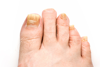 Fungal toenails  treatment in the Monmouth County, NJ: Little Silver (Long Branch, Tinton Falls, Asbury Park, Eatontown, Red Bank, Keansburg) and New York County, NY: New York, as well as Hudson County, NJ: Jersey City, Hoboken, Union City, West New York, Secaucus areas