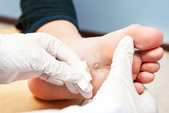 plantar warts treatment in the Monmouth County, NJ: Little Silver (Long Branch, Tinton Falls, Asbury Park, Eatontown, Red Bank, Keansburg) and New York County, NY: New York, as well as Hudson County, NJ: Jersey City, Hoboken, Union City, West New York, Secaucus areas