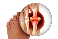 Understanding Gout and How It Differs From Turf Toe