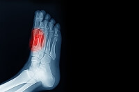 Sesamoiditis and Bone Pain in the Feet