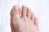 Causes and Symptoms of Ingrown Toenails