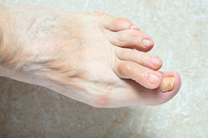 Relieving Hammertoe Discomfort
