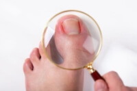 Ingrown Toenails and Prevention Strategies