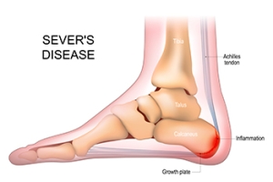 Sever’s Disease Help