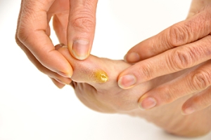 Severe Corns and Calluses on the Feet
